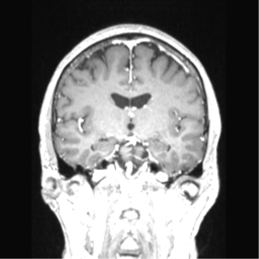 Cerebral arteriovenous malformation with hemorrhage (Radiopaedia 34422-35737 Coronal T1 C+ 49).png