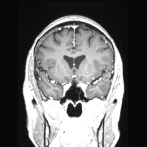 Cerebral arteriovenous malformation with hemorrhage (Radiopaedia 34422-35737 Coronal T1 C+ 60).png