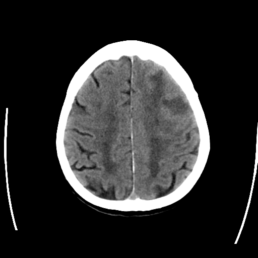 File:Cerebral arteriovenous malformation with lobar hemorrhage (Radiopaedia 44725-48512 Axial non-contrast 26).png
