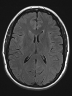 File:Cerebral cavernoma and development venous anomaly (Radiopaedia 37603-39482 Axial FLAIR 13).png