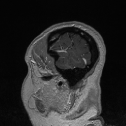 Cerebral cavernoma and development venous anomaly (Radiopaedia 37603-39482 Sagittal T1 C+ 13).png