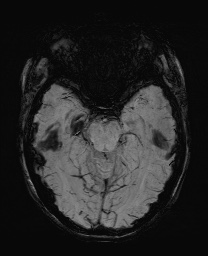Cerebral cavernous venous malformation (Radiopaedia 70008-80021 Axial SWI 24).jpg
