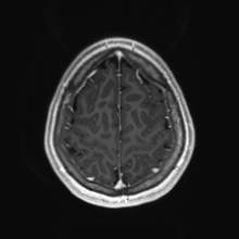 Cerebral cavernous venous malformation (Radiopaedia 70008-80021 Axial T1 C+ 85).jpg