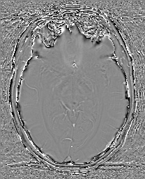 Cerebral cavernous venous malformation (Radiopaedia 70008-80021 G 33).jpg