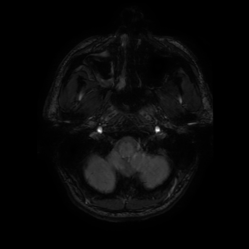 File:Cerebral cavernous venous malformation (Zabramski type II) (Radiopaedia 85511-101198 Axial SWI 16).jpg