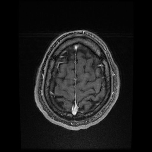 Cerebral cavernous venous malformation (Zabramski type II) (Radiopaedia 85511-101198 Axial T1 C+ fat sat 17).jpg