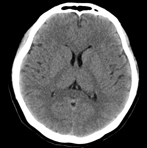 File:Cerebral cavernous venous malformations (Radiopaedia 48117-52945 Axial non-contrast 18).png