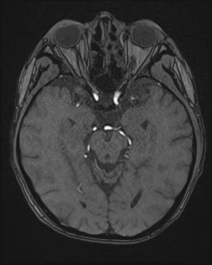 Cerebral embolic infarcts (embolic shower) (Radiopaedia 72391-82921 Axial MRA 60).jpg