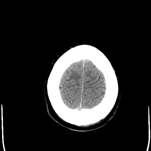 File:Cerebral hemorrhagic contusions- temporal evolution (Radiopaedia 40224-42754 Axial non-contrast 27).png