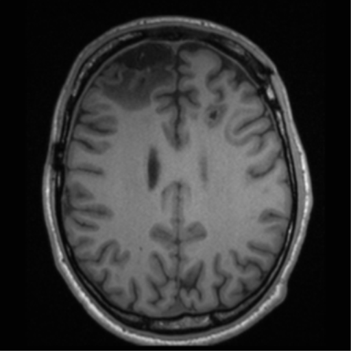 File:Cerebral hemorrhagic contusions- temporal evolution (Radiopaedia 40224-42757 Axial T1 51).png