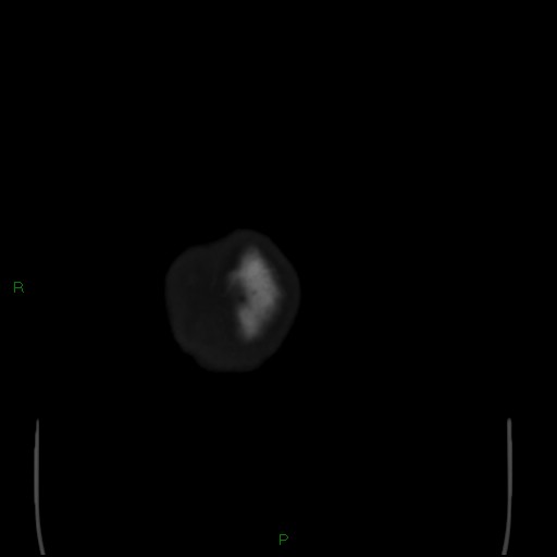 Cerebral metastases - breast primary (Radiopaedia 77653-89857 Axial bone window 121).jpg