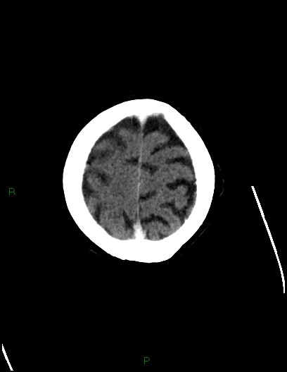 File:Cerebral metastases - ependymal and parenchymal (Radiopaedia 79877-93131 Axial C+ delayed 74).jpg