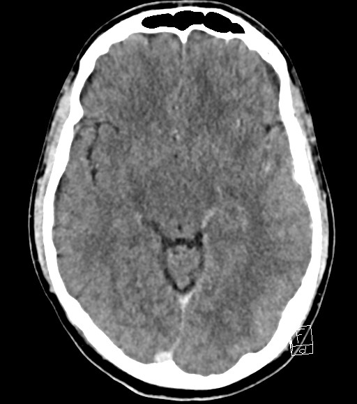 Cerebral metastases - testicular choriocarcinoma (Radiopaedia 84486-99855 Axial C+ delayed 33).jpg