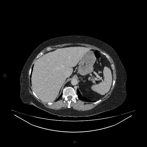 Cerebral metastasis from renal cell carcinoma (Radiopaedia 82306-96378 A 34).jpg
