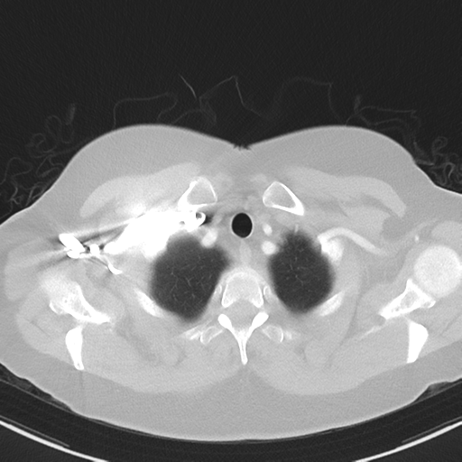 File:Cerebral metastasis mimicking glioblastoma (Radiopaedia 69155-78938 Axial lung window 3).png