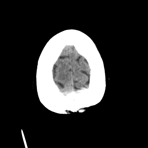 Cerebral metastasis to basal ganglia (Radiopaedia 81568-95412 Axial non-contrast 54).png