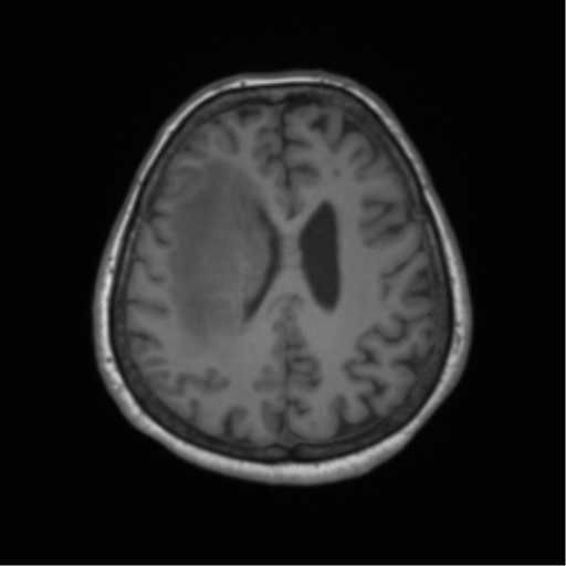 File:Cerebral metastasis to basal ganglia (Radiopaedia 81568-95413 Axial T1 51).png
