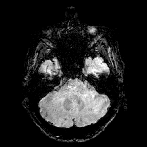 Cerebral parenchymal arteriovenous malformation (Radiopaedia 27280-27456 Axial SWI 19).jpg