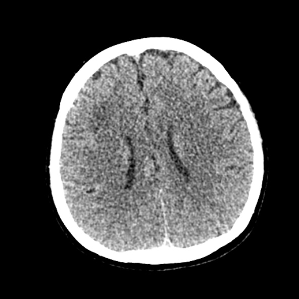 Cerebral ring enhancing lesions - cerebral metastases (Radiopaedia 44922-48818 Axial non-contrast 49).jpg
