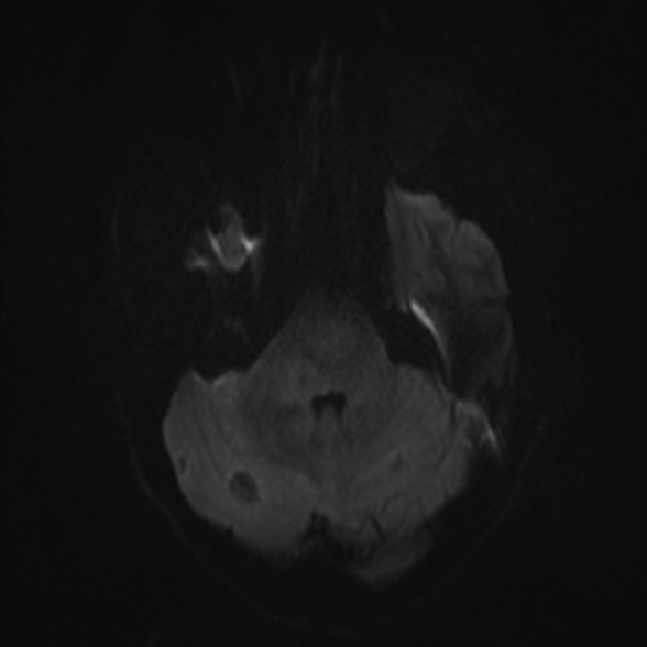File:Cerebral toxoplasmosis (Radiopaedia 53993-60132 Axial DWI 34).jpg