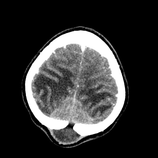 Cerebral tuberculosis with dural sinus invasion (Radiopaedia 60353-68019 Axial C+ delayed 57).jpg