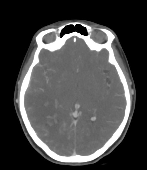 Cerebral venous hemorrhagic infarction (Radiopaedia 38461-40550 Axial MIP VENOGRAM 26).png