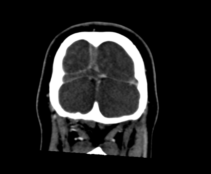 Cerebral venous sinus thrombosis (Radiopaedia 59224-66646 Coronal C+ delayed 71).jpg