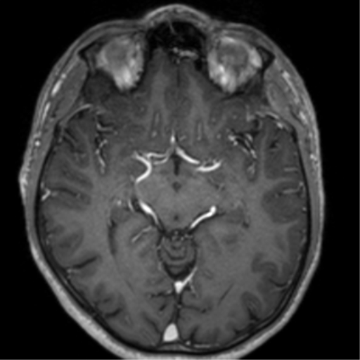 Cerebral venous thrombosis (Radiopaedia 38392-40469 Axial T1 C+ 36).png