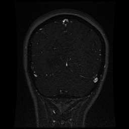 Cerebral venous thrombosis - ulcerative colitis (Radiopaedia 66049-75219 Coronal MRV 30).jpg