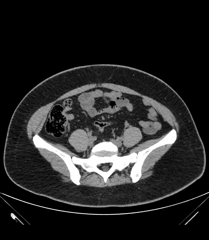 Cervical aortic arch with coarctation and aneurysms (Radiopaedia 44035-47552 Axial non-contrast 77).jpg