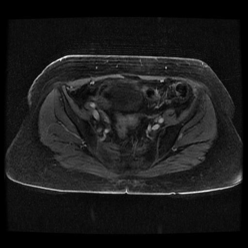 Cervical carcinoma (Radiopaedia 70924-81132 Axial T1 C+ fat sat 239).jpg