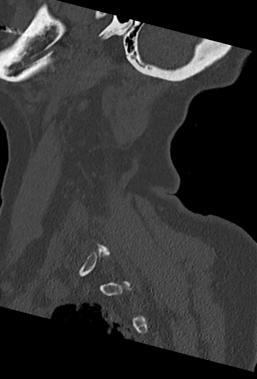 Cervical spine ACDF loosening (Radiopaedia 48998-54070 Sagittal bone window 71).png