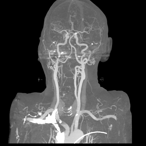 File:Cervical spine fractures with vertebral artery dissection (Radiopaedia 53296-59269 3D MIP 26).png