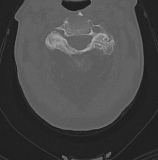 File:Cervical spondylolysis (Radiopaedia 49616-54811 Axial bone window 21).png