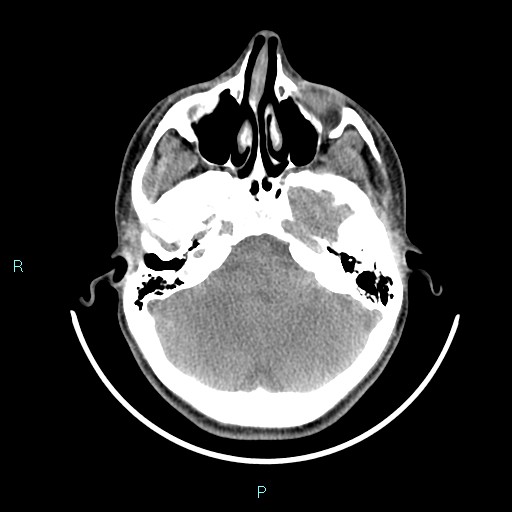 Cervical thymic cyst (Radiopaedia 88632-105335 Axial non-contrast 112).jpg