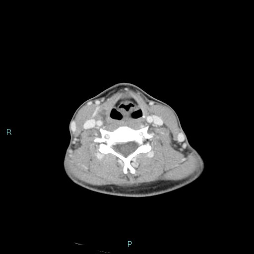 Cervical thymic cyst (Radiopaedia 88632-105335 C 54).jpg