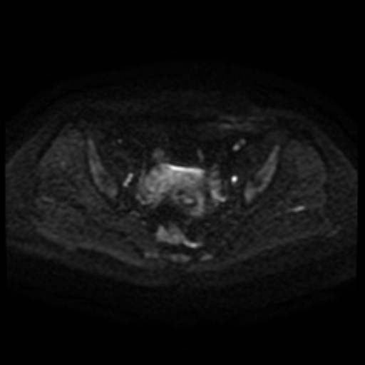 Cesarian section scar endometriosis (Radiopaedia 66520-75799 Axial DWI 87).jpg