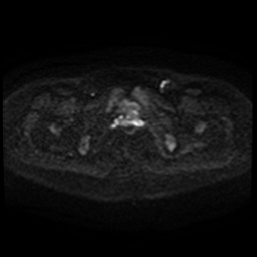 Cesarian section scar endometriosis (Radiopaedia 66520-75799 Axial DWI 97).jpg