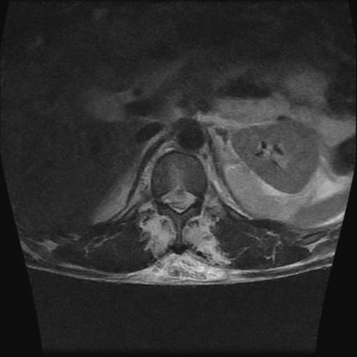 File:Chance type fracture (Radiopaedia 31020-31725 Axial T2 15).jpg