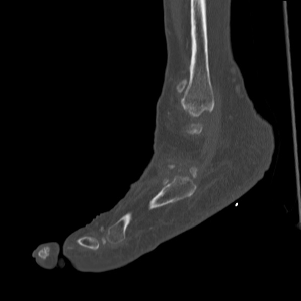 Charcot joint (Radiopaedia 36629-38194 Sagittal bone window 30).jpg