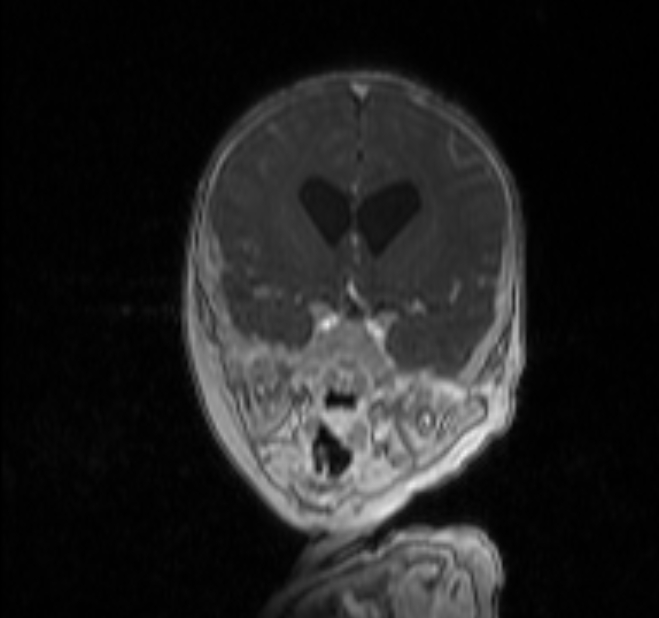 Chiari III malformation with occipital encephalocele (Radiopaedia 79446-92559 Coronal T1 C+ mpr 7).jpg