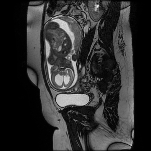 File:Chiari II malformation - fetal MRI (Radiopaedia 68099-77581 Sagittal Fiesta 19).jpg