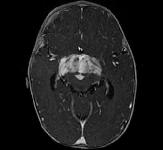 Chiasmatic-hypothalamic glioma (Radiopaedia 90079-107252 Axial T1 C+ 36).jpg