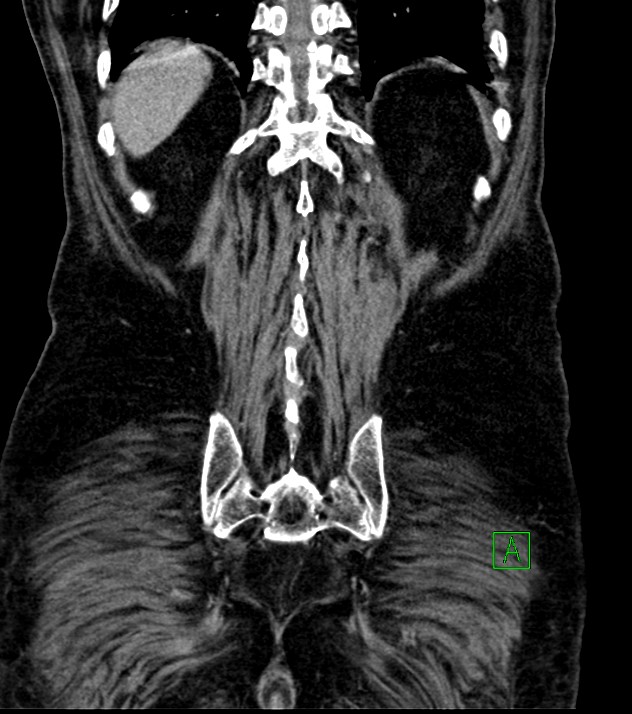 Cholangiocarcinoma with cerebral metastases (Radiopaedia 83519-98629 G 69).jpg
