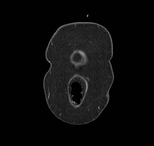 File:Cholecystoduodenal fistula (Radiopaedia 48959-54022 B 4).jpg