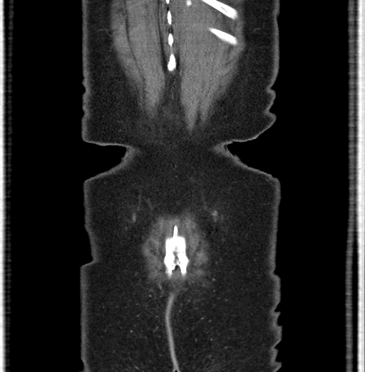 File:Cholecystoduodenal fistula due to calculous cholecystitis with gallstone migration (Radiopaedia 86875-103077 B 45).jpg