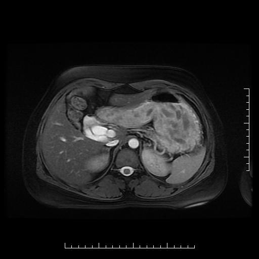 File:Choledochal cyst with chronic calcific pancreatitis (Radiopaedia 18245-18062 Axial T2 6).png