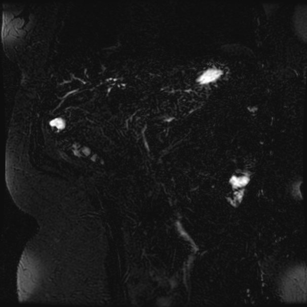 Choledocholithiasis on CT and MRI (Radiopaedia 24825-25088 Coronal T2 74).jpg