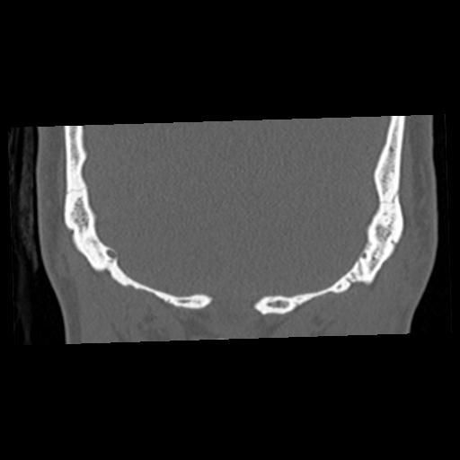 Cholesteatoma (Radiopaedia 84960-100474 Coronal bone window 67).jpg