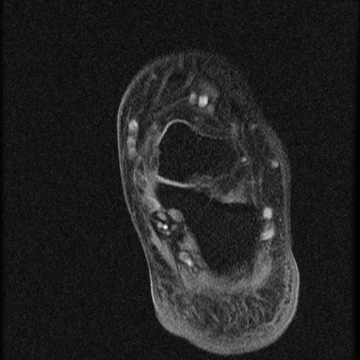 File:Chondroblastoma - midfoot (Radiopaedia 64831-73765 F 3).jpg